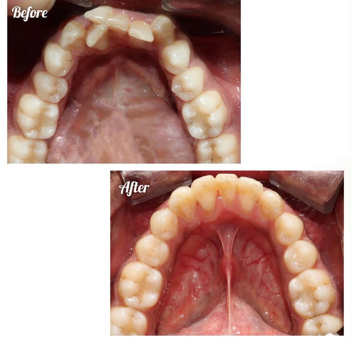 Palatal Arch Expansion - Before & After Clinical Result