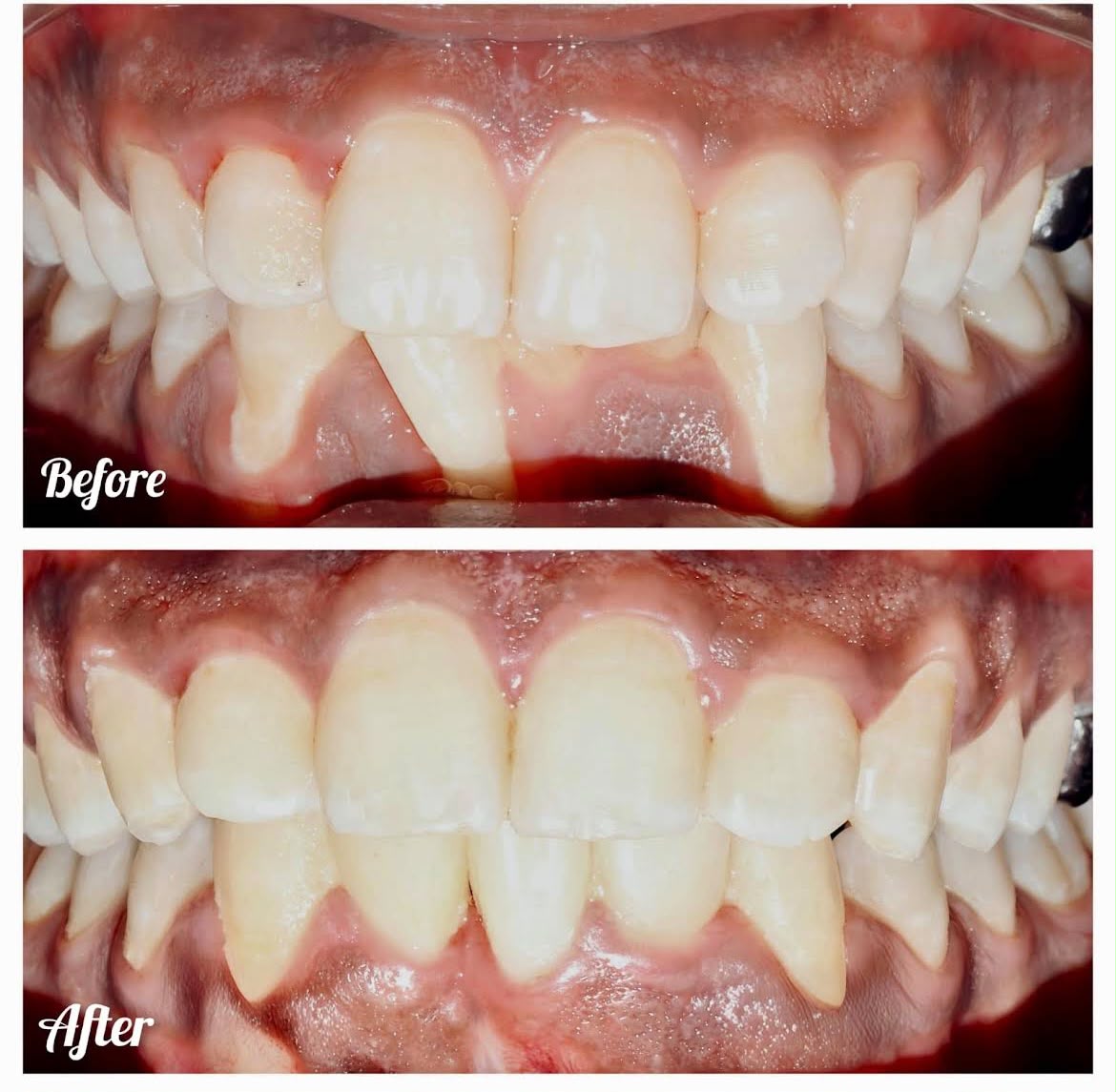Anterior Crossbite Correction - Before & After Clinical Result