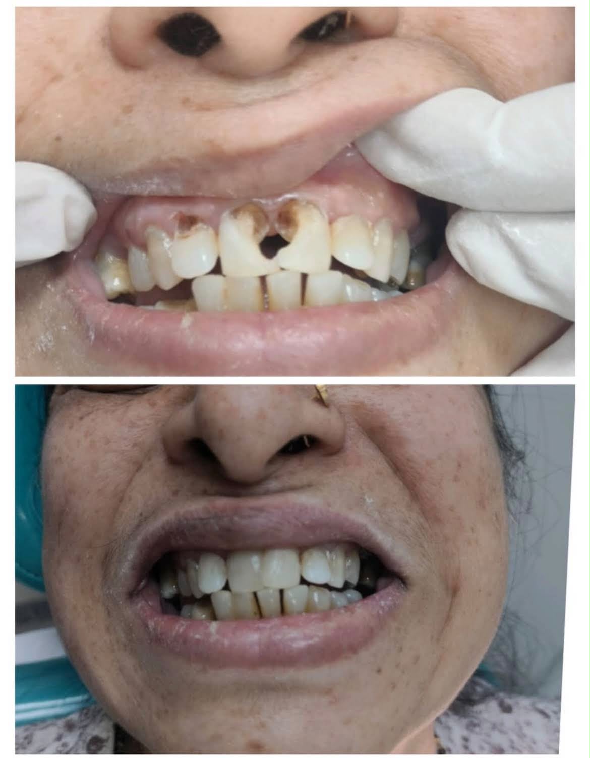 Full Smile Aesthetic Rehabilitation - Before & After Clinical Result